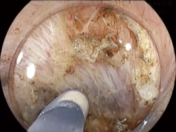 Clinical Image ：Submocosal injection
