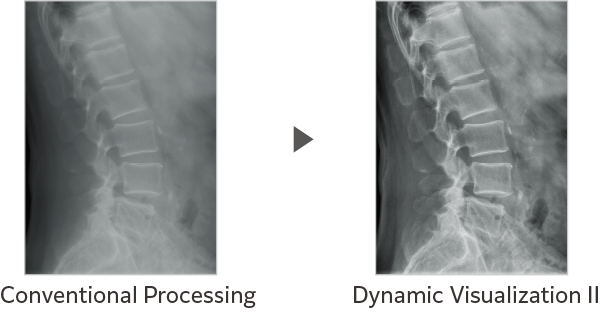 Comparison of Dynamic Visualization II vs. conventional processing images (Lumbar Spine)